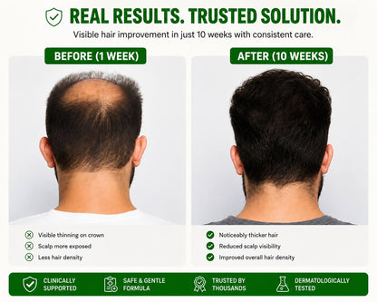 HAIR REGROWTH SYSTEM